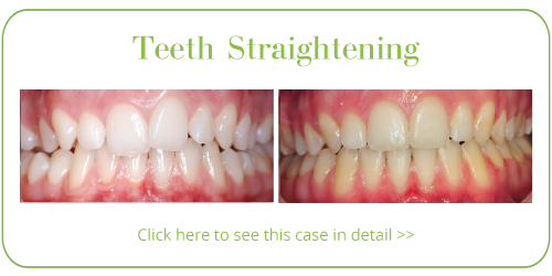 Teeth Straightening Skegness